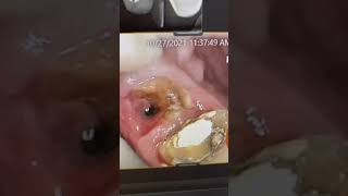 Part 2: More On The Case With The Guy With Archaic Materials In His Mouth