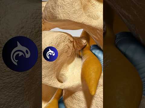 Foraminal Stenosis of the Spine