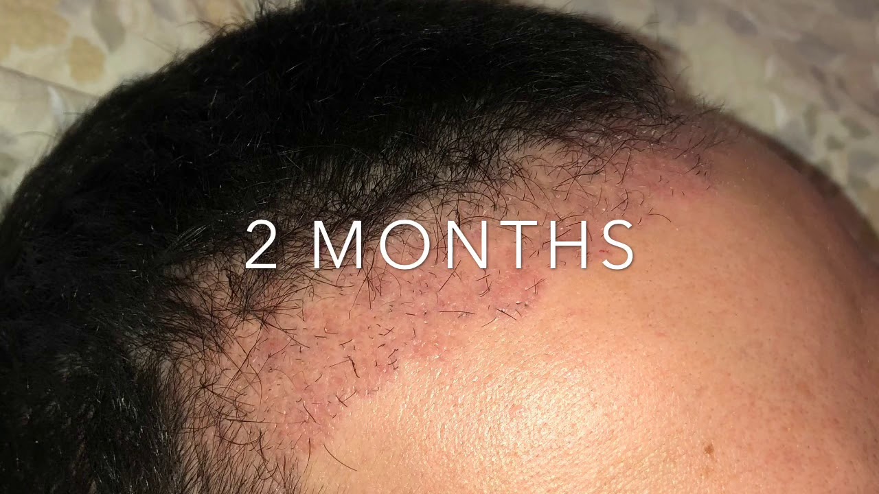 Trapianto Capelli Giorno per Giorno, da giorno 1 a 6 mesi - Hair transplant Day By Day