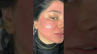 Micro needling/prp for acne pitted scars. #acne #acnescars #scarstreatment #acnescarremoval