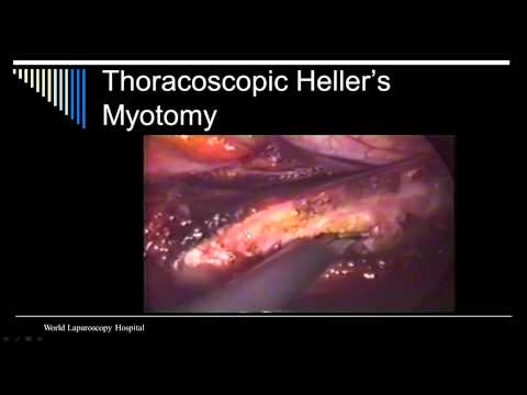 Master Class of Hellers Myotomy