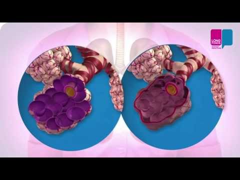 COPD – What Happens in Your Lungs?