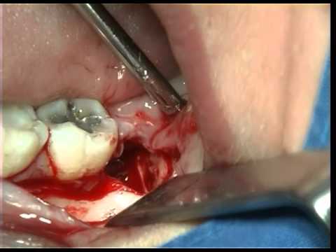 Chirurgiczne usunięcie zatrzymanego zęba mądrości