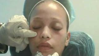 Non Surgical Eye Lift | Dark Circles Removal in New York