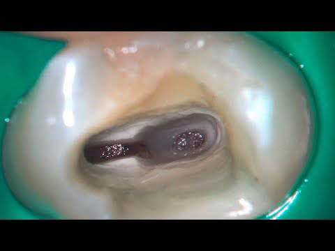 Deep partial pulpotomy in a maxillary premolar. Domenico Ricucci.