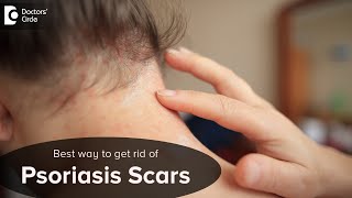 WILL PSORIASIS SCARS GO AWAY? Know the Main Causes & Symptoms - Dr. Chaithanya K S| Doctors