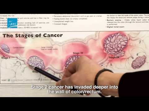 Colorectal cancer updates