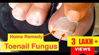 Home Remedy Cure for Toenail Fungus | The Best Nail Fungus Treatment Cure with Vicks VapoRub
