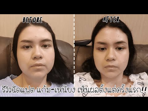 เมโสแฟต ยี่ห้อไหนดี