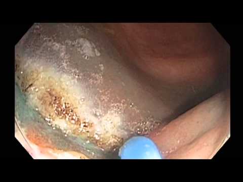 Colonoscopy: EMR of a Flat Lesion in Cecum 