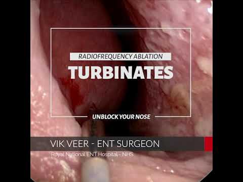 Celon RFA Turbinate Reduction