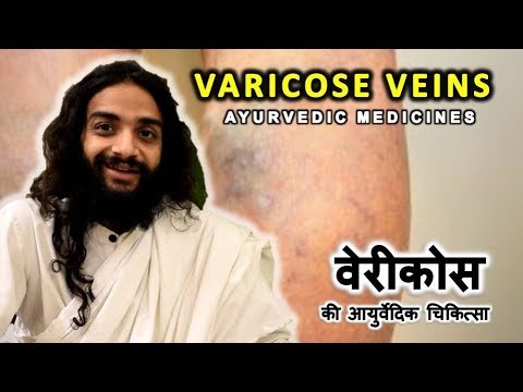 cum trateaza ayurveda varicoza