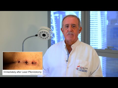 Pilonidal Cyst The Minimally Invasive Laser Solution - Dr. Abdul Ghani Dandan - Laven Clinic