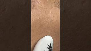 Watch These Blackheads Disappear 😂 #shorts #blackheads #acne