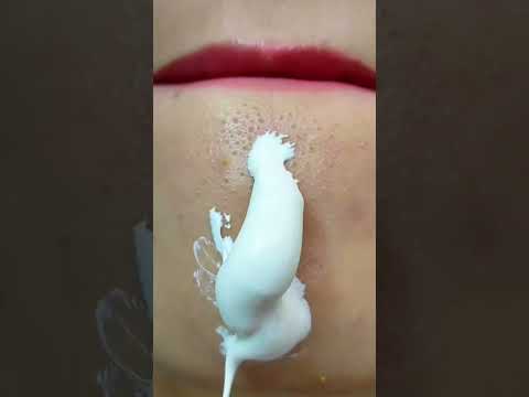 chin blackheads whiteheads removing with colgate at home remedy. .....
