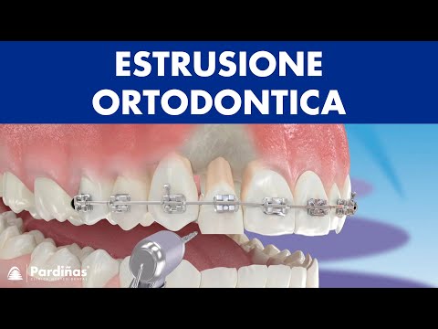 Estrusione ortodontica ©