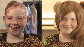 11-Year-Old Girl Scalped From Carnival Ride Gets Wig For First Day of School