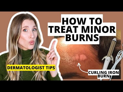 Dermatologist Explains How to Treat Minor Burns & Minimize Scarring | Dr. Sam Ellis