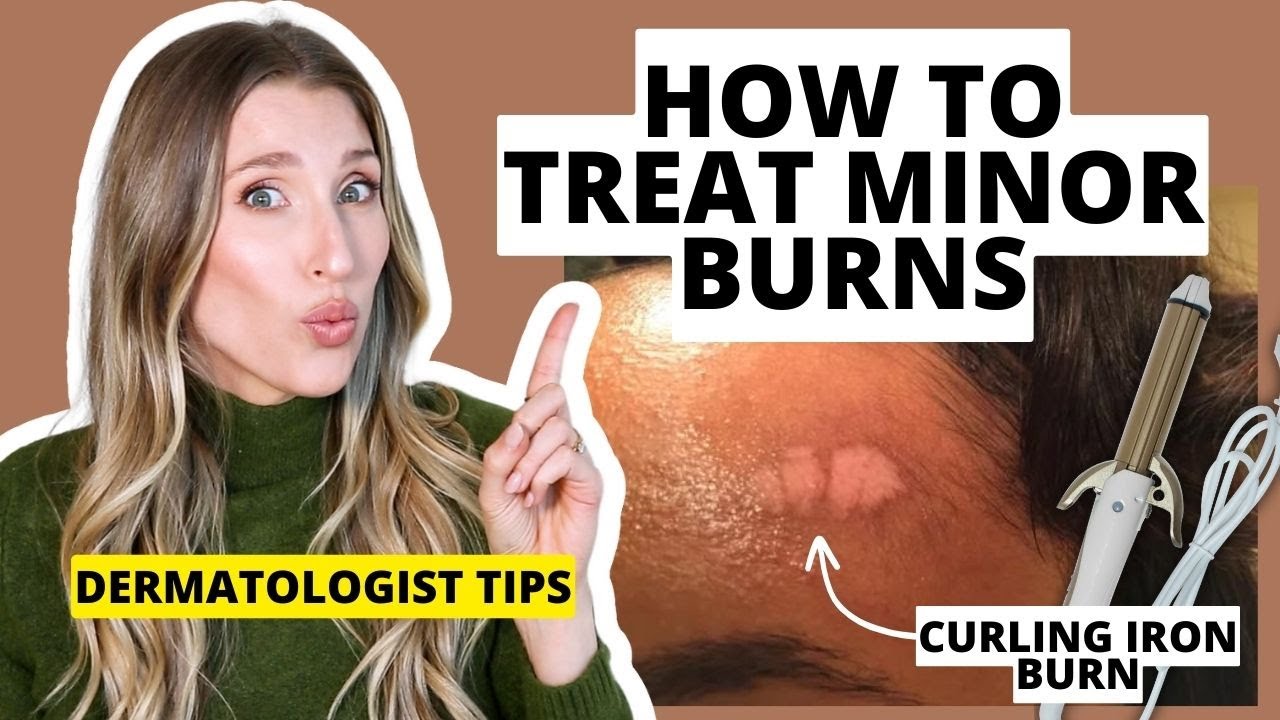 Dermatologist Explains How to Treat Minor Burns & Minimize Scarring | Dr. Sam Ellis
