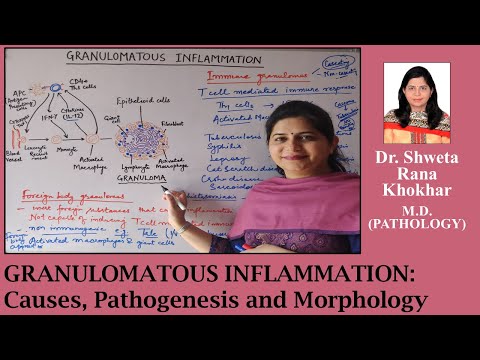 Granulomatous Inflammation: Causes, Pathogenesis and Morphology | Immune and Foreign body granulomas