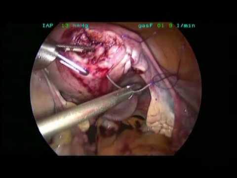 Laparoscopic Barbed Stitching Application In Gynecology