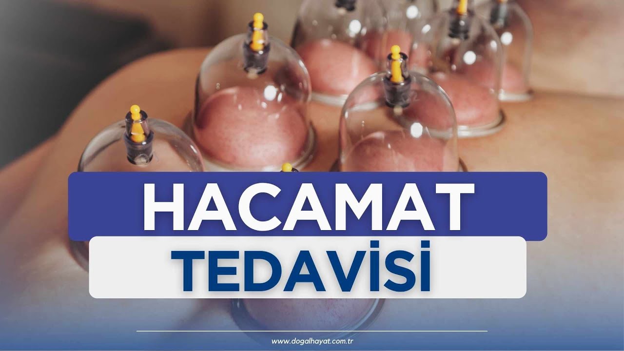 Hacamat Tedavisi