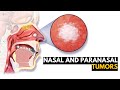 Nasal and Paranasal Tumors, Causes, Signs and Symptoms, Diagnosis and Treatment.