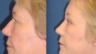 preview picture of video 'Brow lift for Droopy Eyelids with Dr Ricardo Rodriguez in Baltimore'