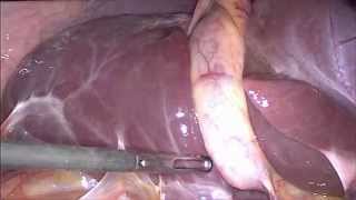 La colecistectomia laparoscopica - Casa del Sole-Formia