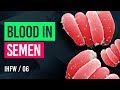 BLOOD IN SEMEN | HEMATOSPERMIA