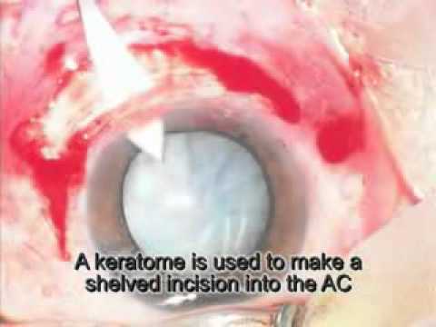 ECCE: Extra-Capsular Cataract Extraction