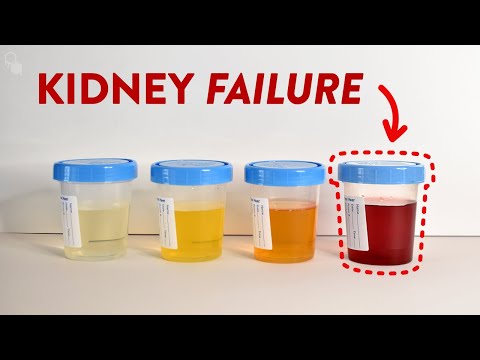 This is Kidney Failure
