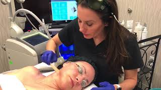 Limelight Laser Treatment