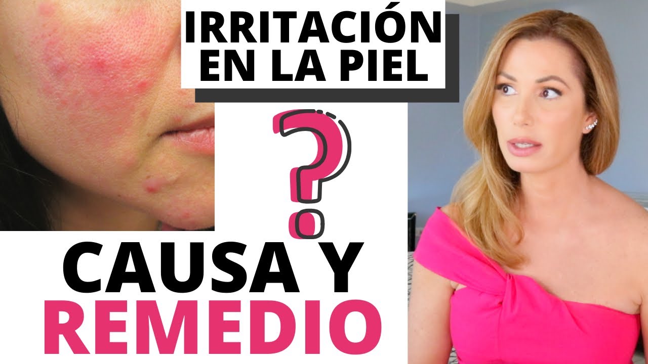 ACNÉ O ROSÁCEA IRRITACIÓN EN LA PIEL CAUSA Y REMEDIO | Desiree Lowry