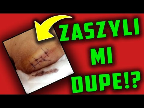 Deformacja stawów palców Deformacja płytki paznokciowej leczenie palce