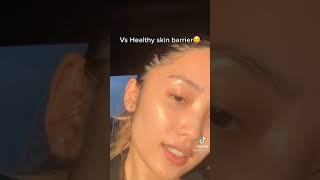 FROM ACNE TO CLEAR SKIN JOURNEY |SKINCARE TIKTOK #SHORTS