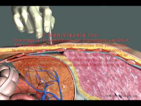 Thoracostomy:  Improper Procedure