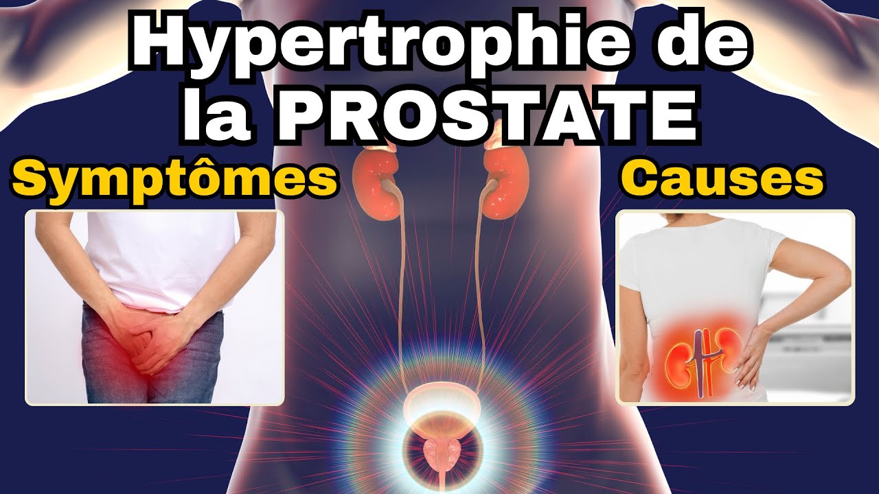 SYMPTÔMES les plus fréquents de l'HYPERTROPHIE BENIGNE DE LA PROSTATE (HBP)
