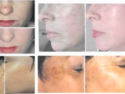 IPL Laser Therapy - Listowel Therapy Centre