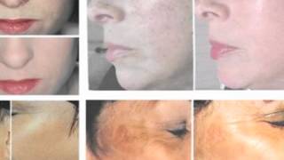 preview picture of video 'IPL Laser Therapy - Listowel Therapy Centre'