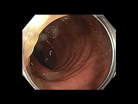 Colonoscopia - pólipos múltiples y estenosis sigmoidea - resección diferida para rediscutir