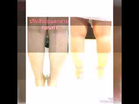 เป็นบ้านของ 2 หน้าอกขยาย การปลูกถ่ายใหม่ในหน้าอก