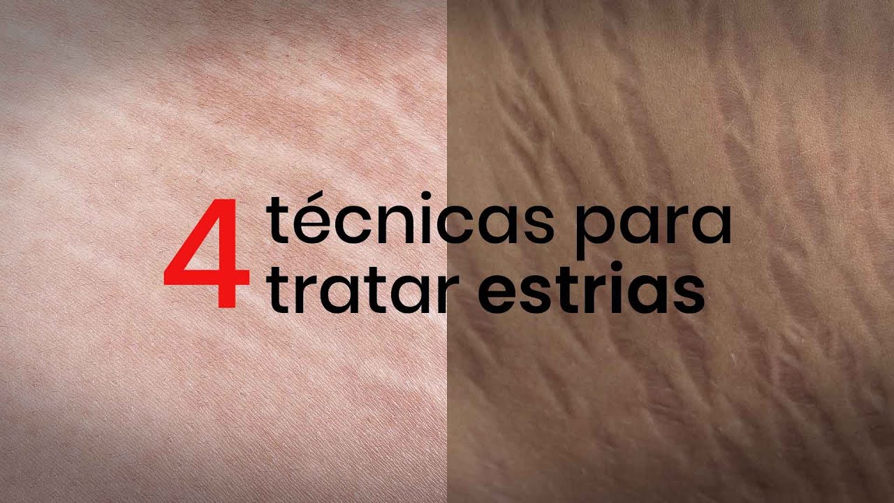 4 técnicas para tratar estrias