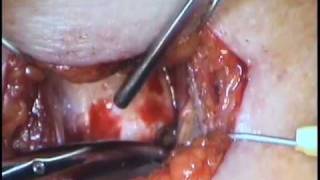 Medialization Laryngoplasty