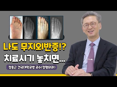 무지외반증! 반드시 수술이 필요할까?