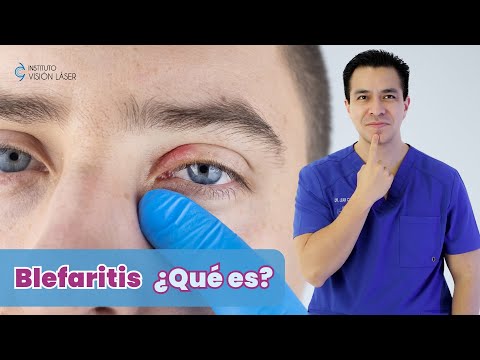Blefaritis ¿Qué es?