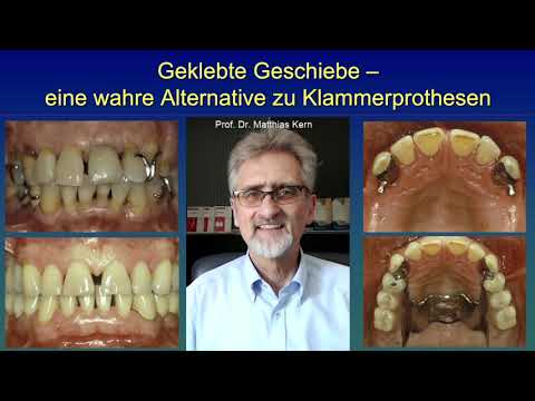 Geklebte Geschiebe oder sog. Adhäsivattachments - eine exzellente Alternative zu Klammerprothesen