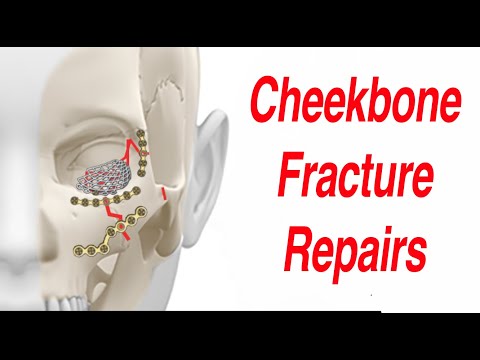 Stativ- und andere Wangenknochen-Gesichtsfrakturen