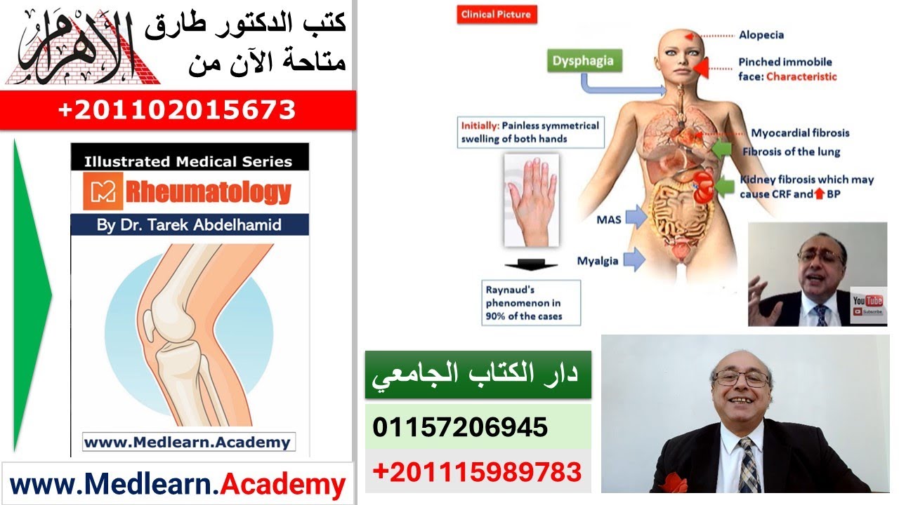 Scleroderma (Systemic Sclerosis)   #cme #internal_medicine  #usmle  #medical #محاضرات_باطنة