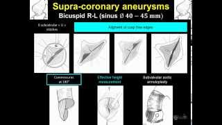 A/Prof George Matalanis: Aortic valve repair & valve-sparing aortic root replacement